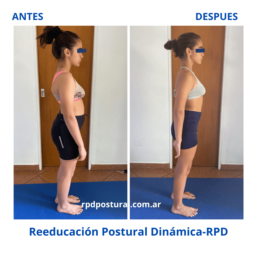 Comparativa plano sagital derecho- Federica Marti (1)